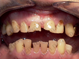 Адгезивная реставрация патологической стираемости зубов (ДО)