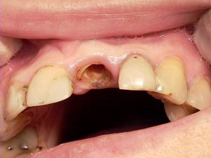 Корень зуба после удаления коронки зуба и штифтов