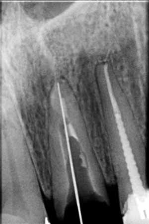 Канал зуба распломбирован до верхушечного отверстия. Рентгеновский снимок с инструментом