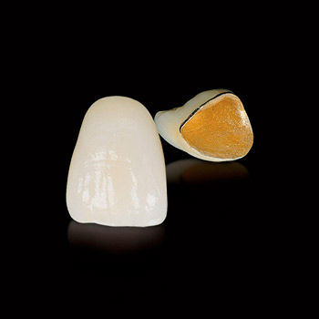 Металлокерамические зубные коронки